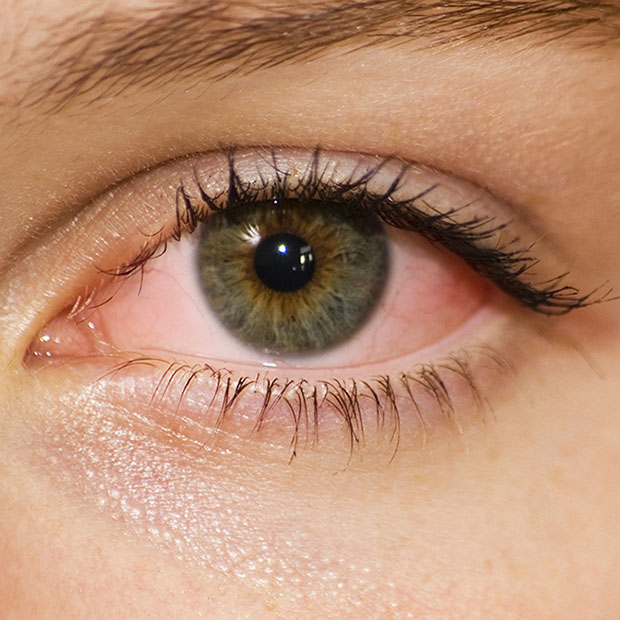The Basics of Pink Eye Perris CA Dr. Barnes Optometry